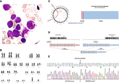 Case Report: Co-existence of a novel EXOC4‐TRHDE gene fusion with PML-RARA in acute promyelocytic leukemia